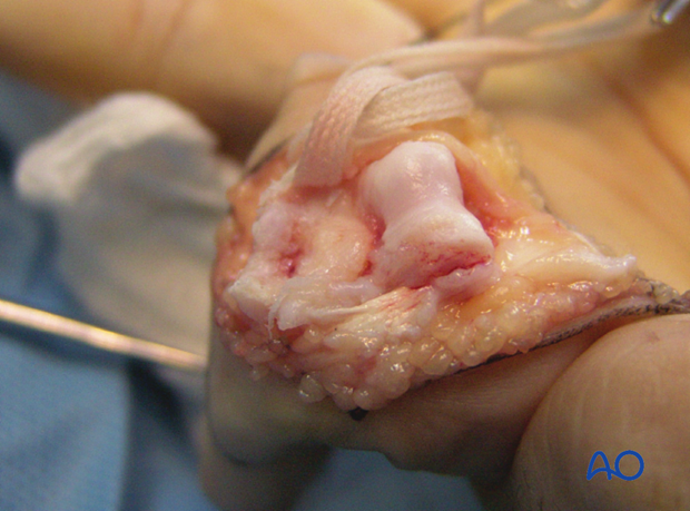 Clinical image of fully opened proximal interphalangeal joint exposes base of middle phalanx