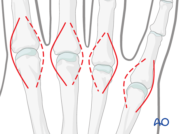 Dorsal approach skin incisions to the metacarpophalangeal joints