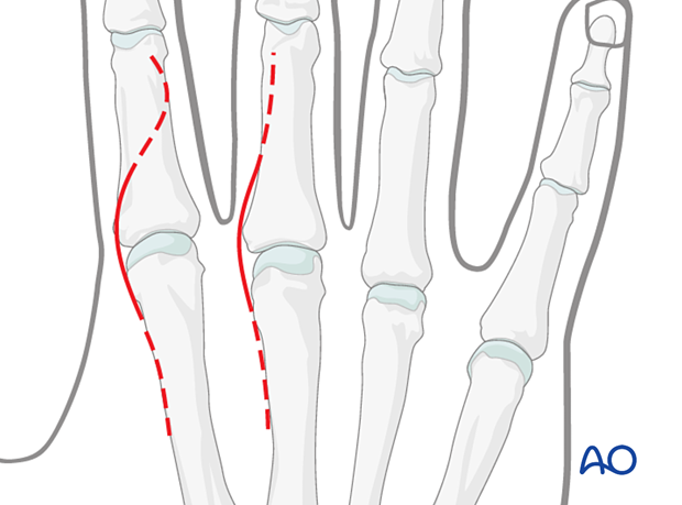 Dorsal approach to metacarpophalangeal joint - proximal and distal skin incision extensions