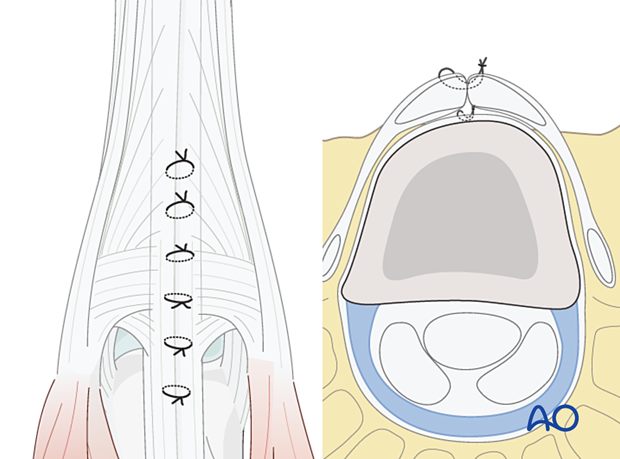 Joint capsule and tendon repair with sutures