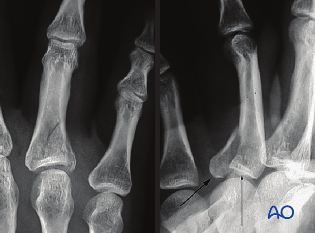 X-rays of an articular fracture of the proximal phalangeal base