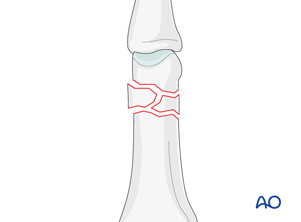 AP view of a multifragmentary extraarticular fracture of the distal end segment- Proximal phalanx hand