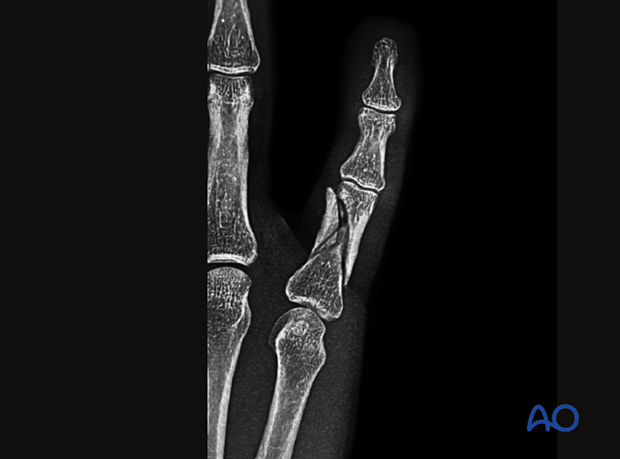 AP x-ray a multifragmentary extraarticular fracture of the distal end segment- Proximal phalanx hand