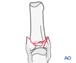 Proximal end segment complete articular