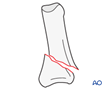 Proximal end segment extraarticular