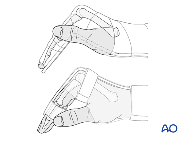 Patient with arm in a well-padded below-elbow splint