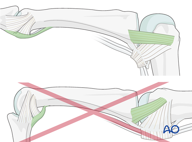 The metacarpophalangeal joint in flexion maintains the collateral ligament at maximal length and the proximal interphalangeal in extension maintains the length of the volar plate.