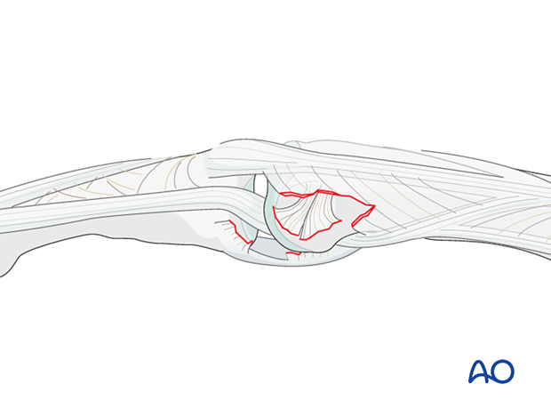 Soft-tissue interposition of the lateral band with the condyle trapped between the lateral band and the central slip resulting in visible widening of the joint space.