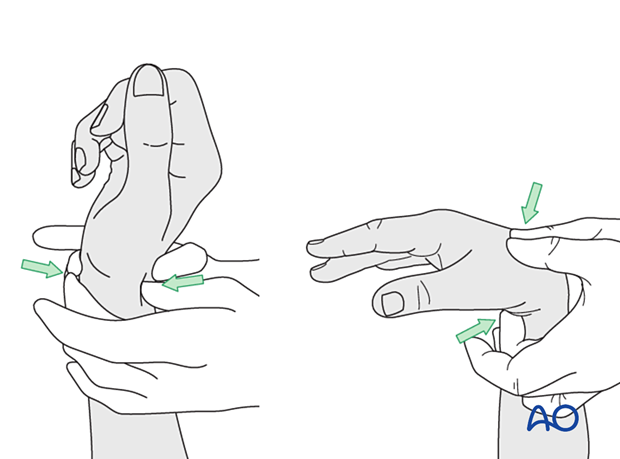 Surgeon fully flexing the wrist to produce extension of the fingers and fully extending the wrist to cause flexion of the fingers