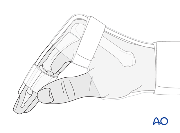 Nonoperative treatment with splinting for undisplaced or minimally displaced diaphyseal and stable proximal extraarticular metacarpal fractures