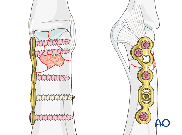 Plate fixation of a complete articular fracture of the proximal phalangeal head