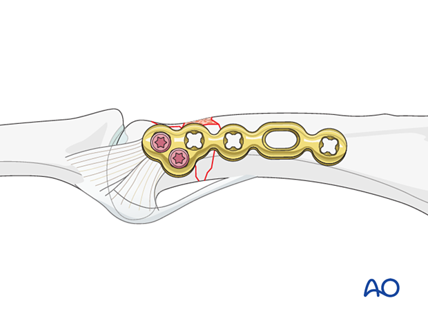 Plate fixation of a complete articular fracture of the proximal phalangeal head – inserting the first screws 