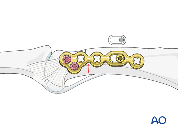 Compression plating of a complete articular fracture of the proximal phalangeal head