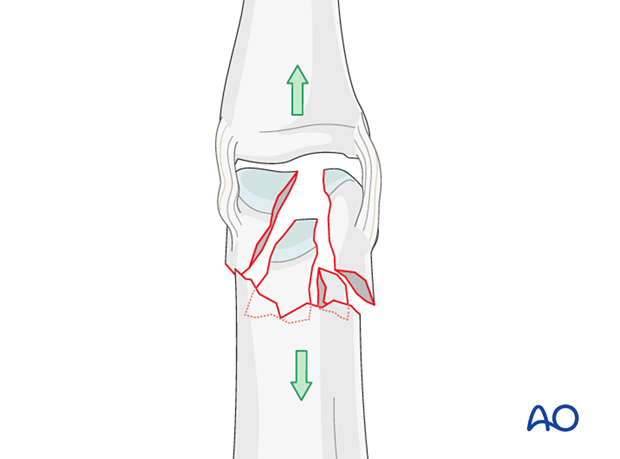 Reduction of a complete articular fracture of the proximal phalangeal head by traction