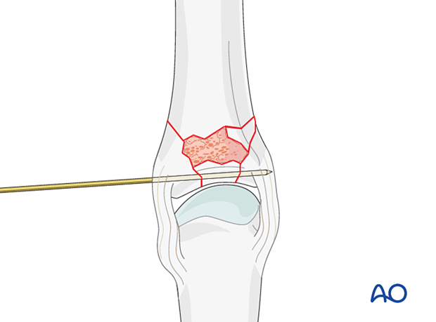 Bone graft added to a bone defect in a multifragmentary proximal articular fracture of a proximal phalanx