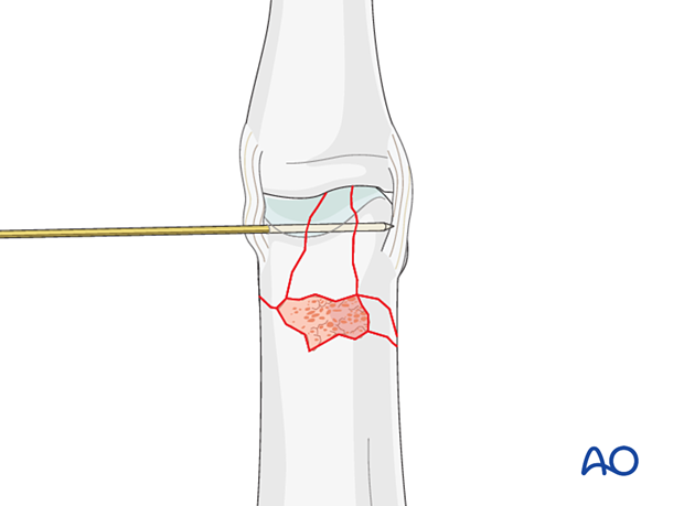 Reduced complete articular fracture of the proximal phalangeal head with a K-wire and bone graft