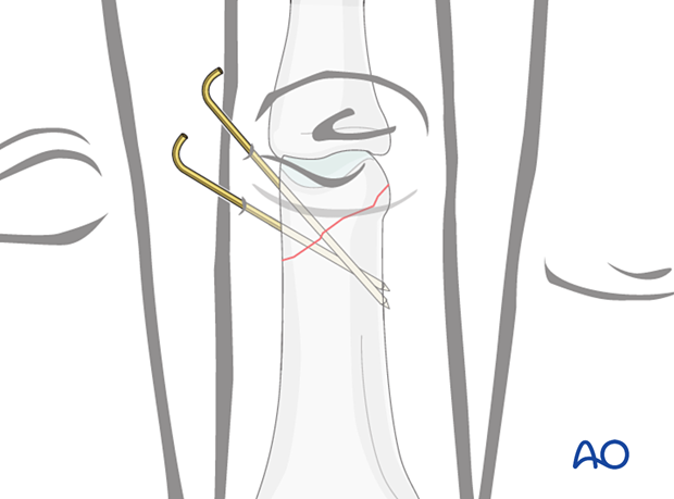 K Wire Fixation For Oblique Extraarticular Fracture Of The Distal End