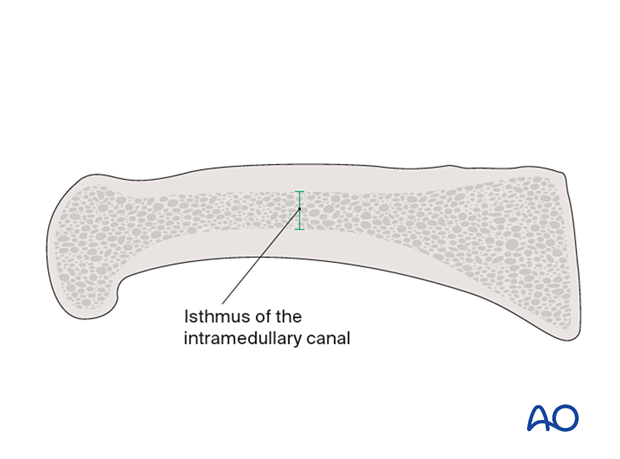 Cross section of a proximal phalanx with the isthmus of the intramedullary canal indicated