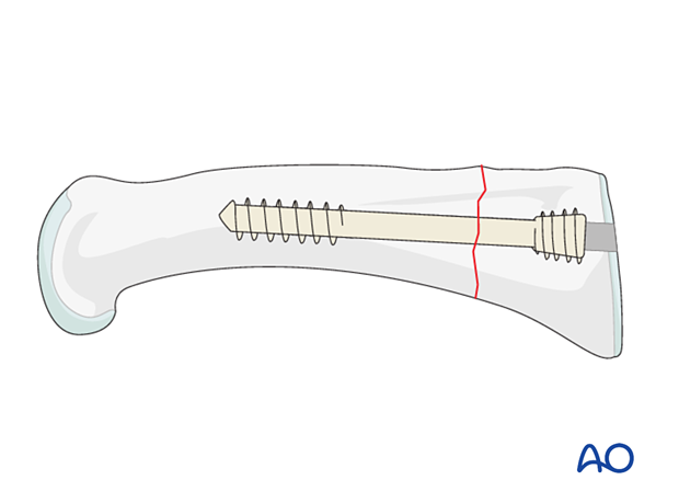 Intramedullary screw fixation of a transverse fracture of the proximal phalangeal distal end segment