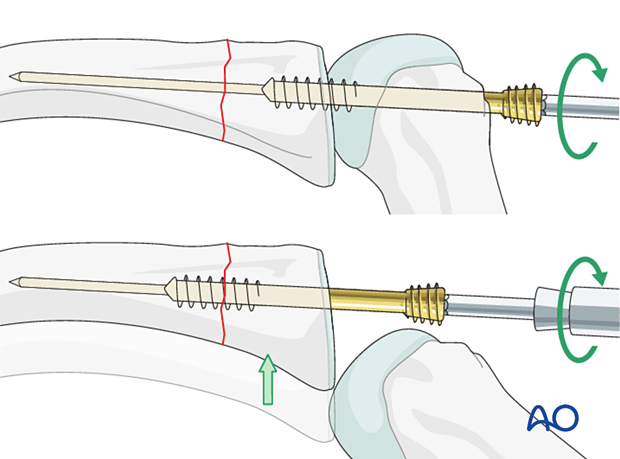 Intramedullary screw fixation of a transverse fracture of the proximal phalangx with antegrade screw insertion in a trans- and intraarticular fashion