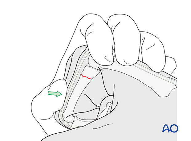 Reduction of a transverse fracture of the proximal phalangeal proximal end segment