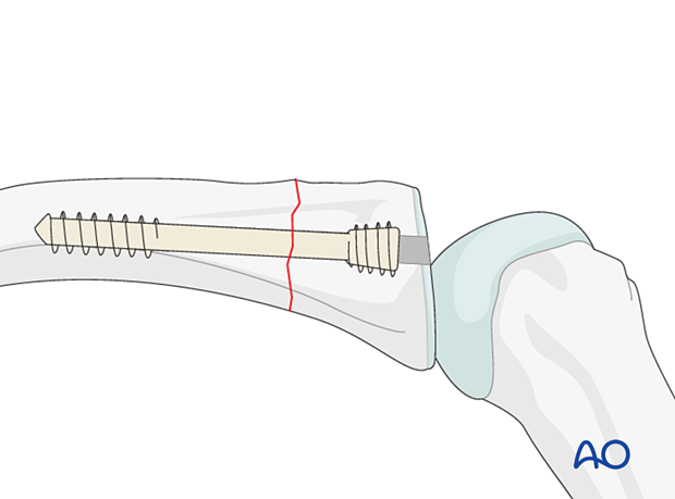 Intramedullary screw fixation of a transverse fracture of the proximal phalangeal proximal end segment – Antegrade intraarticular screw insertion