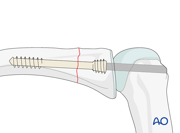 Intramedullary screw fixation of a transverse fracture of the proximal phalangeal proximal end segment – Antegrade transarticular screw insertion