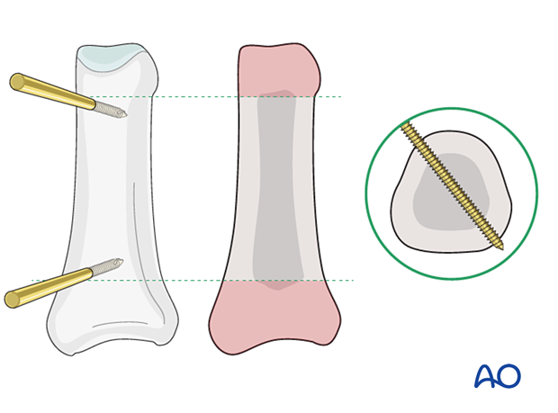 Placement of K-wires for optimal stabilization – external fixation of diaphyseal wedge or multifragmentary fractures – proximal phalanx – hand.