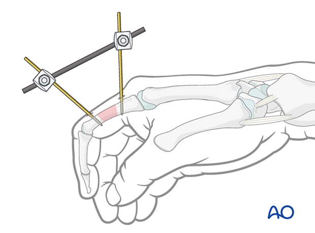 First two K-wires, rod-to-wire clamps and rod construct – external fixation of diaphyseal wedge or multifragmentary fractures – proximal phalanx – hand