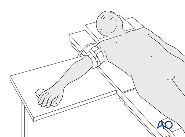 Patient positioned supine with the arm on a radiolucent hand table