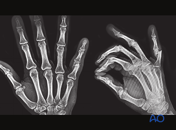 Nonunion of an extraarticular fracture of the 5th proximal phalangeal head of the hand