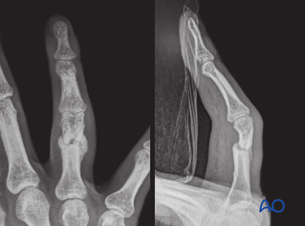 Malunion of a shaft fracture of the proximal phalanx of the hand