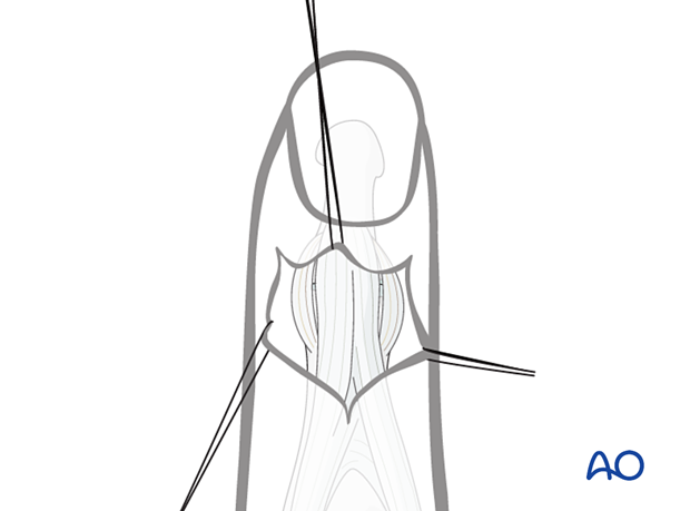 Elevated skin flaps of a dorsal approach to the DIP joint