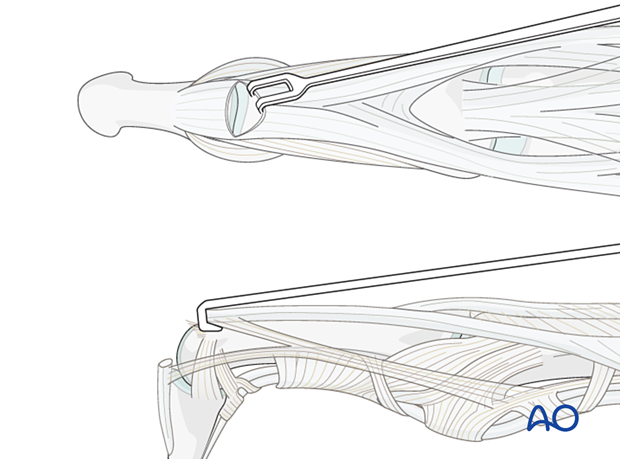 Retraction of the terminal extensor tendon to expose the DIP joint