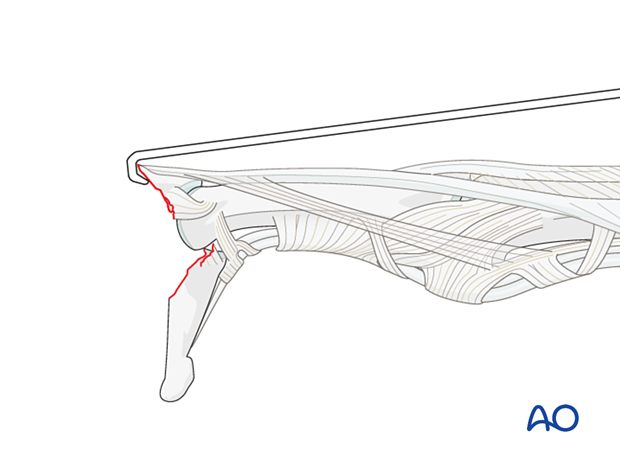 Retraction of a dorsal avulsion fragment to expose the DIP joint