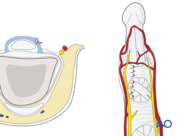 Reattachment of A5 and C3 pulleys after palmar approach to the DIP joint