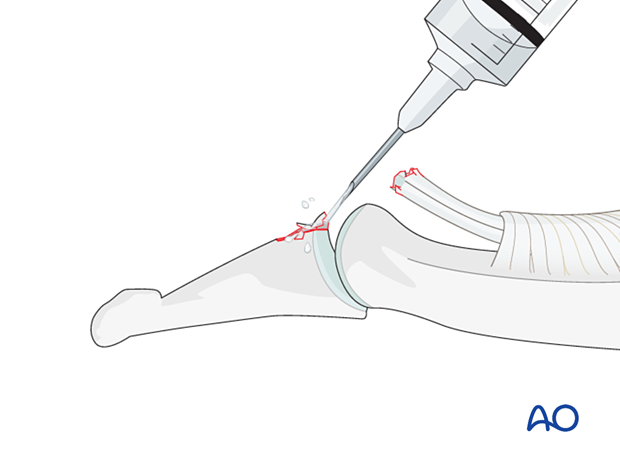 Removal of blood clots of a palmar avulsion of the distal phalangeal base