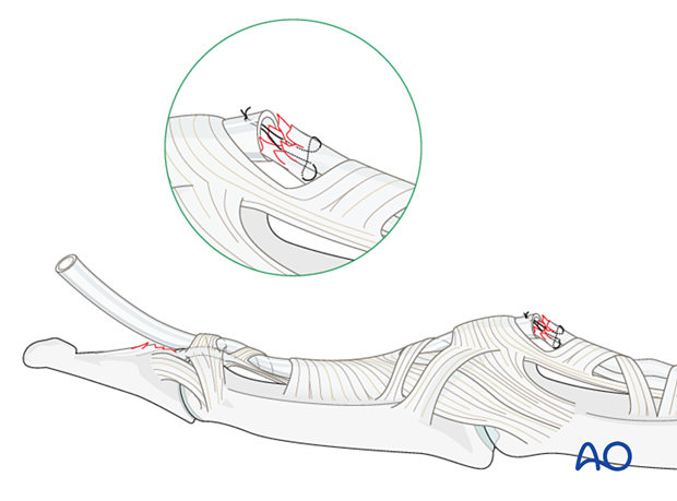 Repositioning the avulsed flexor digitorum profundus (FDP) tendon