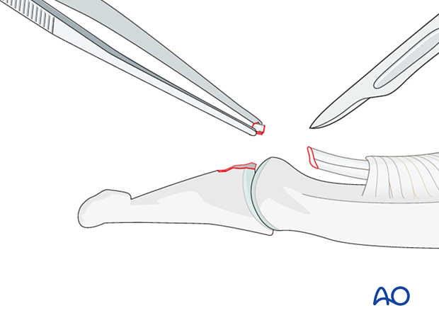 Resection of small fragments of a palmar avulsion of the distal phalangeal base