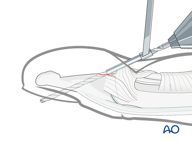 Drilling for suture fixation of a palmar avulsion of the distal phalangeal base