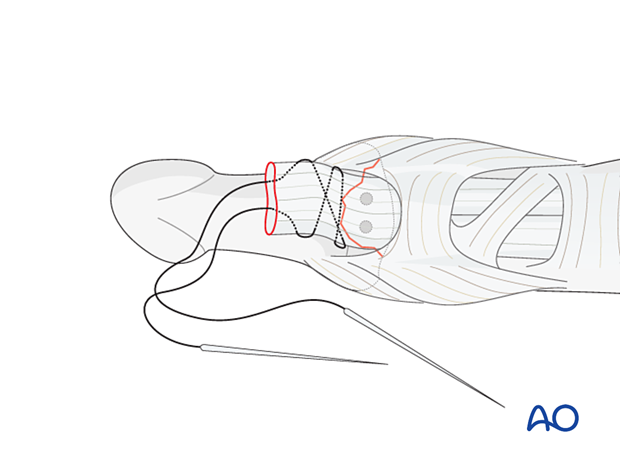 Inserting the suture into the avulsed end of the flexor digitorum profundus (FDP) tendon