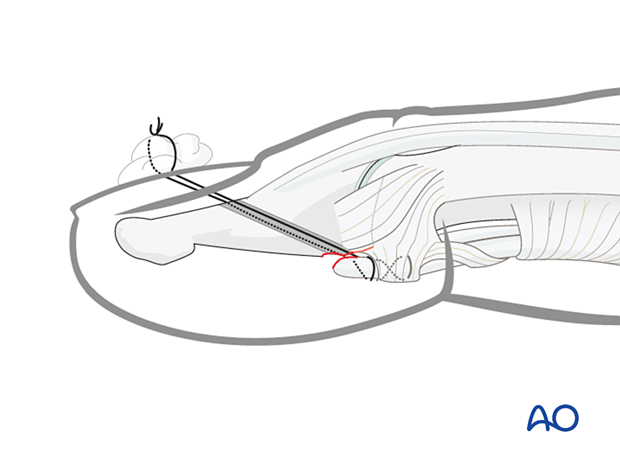 Suture fixation of a palmar tendon avulsion of the distal phalangeal base