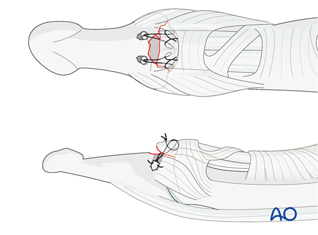 Suture anchor fixation of an avulsed flexor digitorum profundus (FDP) tendon