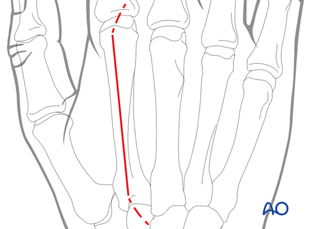 Dorsal approach to the second metatarsal