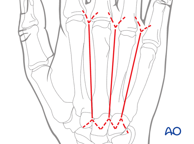 Dorsal skin incisions to approach neighboring metacarpal