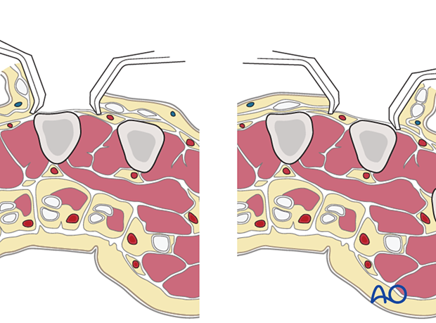 Cross section of a dorsal approach to adjacent metacarpals