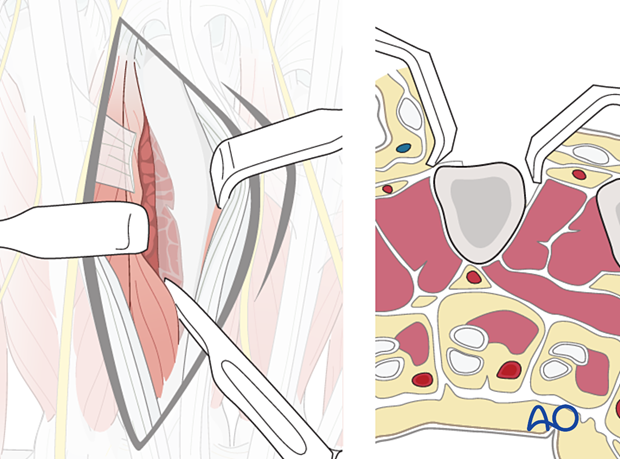 Detachment of interosseous muscles of the metacarpals