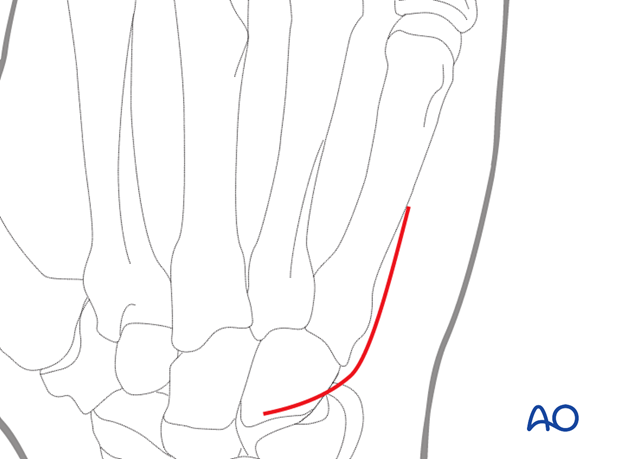 Dorsal approach to the 5th carpometacarpal joint