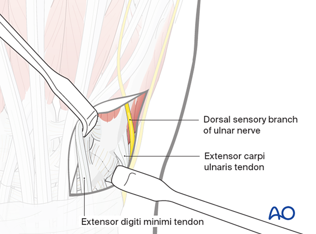 Retraction of extensor tendons during a dorsal approach to the 5th carpometacarpal joint