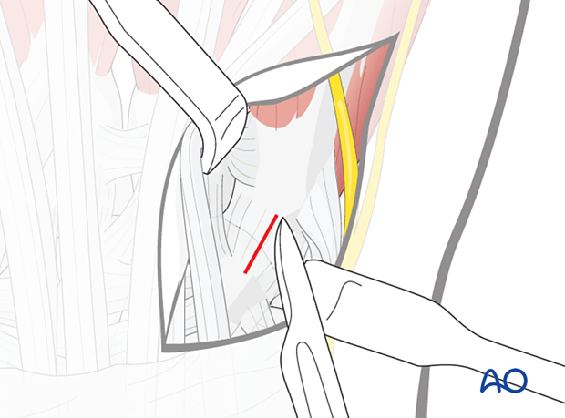 Capsulotomy of the 5th carpometacarpal joint